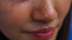 Oily Skin
